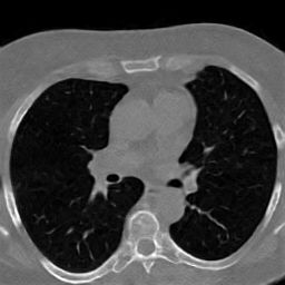 Animated LAND axial chest CT sample 1.