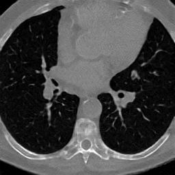 Animated LAND axial chest CT sample 2.