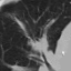 Lung CT baseline, axial slice 33