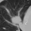 Lung CT true follow-up, axial slice 33
